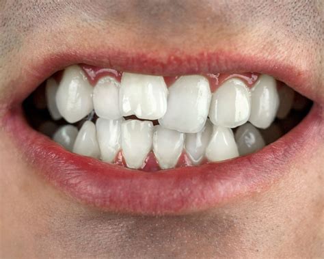 Magic teeth brasr instant smile veneers